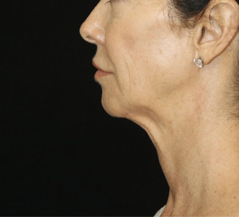 Facelift & Neck Lift Before & After Gallery - Patient 173372092 - Image 5