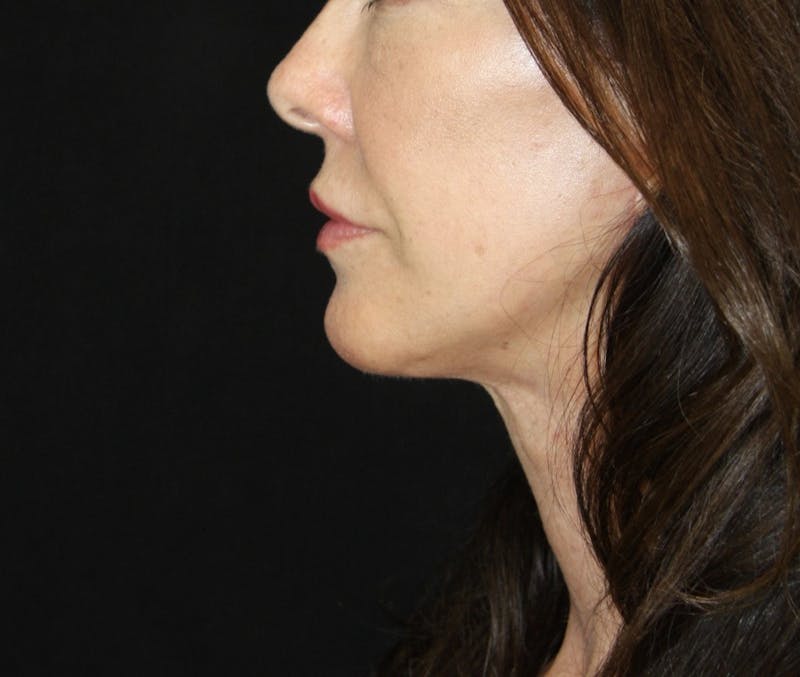 Facelift & Neck Lift Before & After Gallery - Patient 173372092 - Image 6