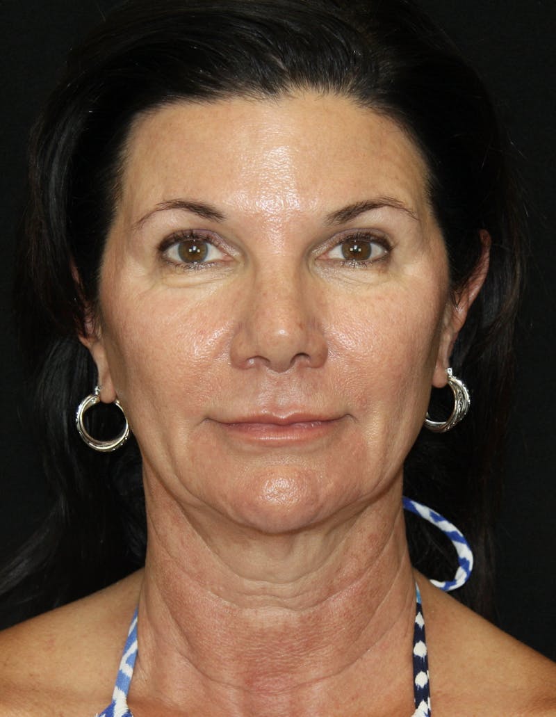 Facelift & Neck Lift Before & After Gallery - Patient 173372158 - Image 1