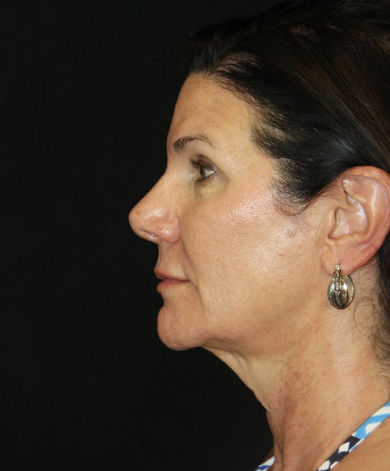 Facelift & Neck Lift Before & After Gallery - Patient 173372158 - Image 3