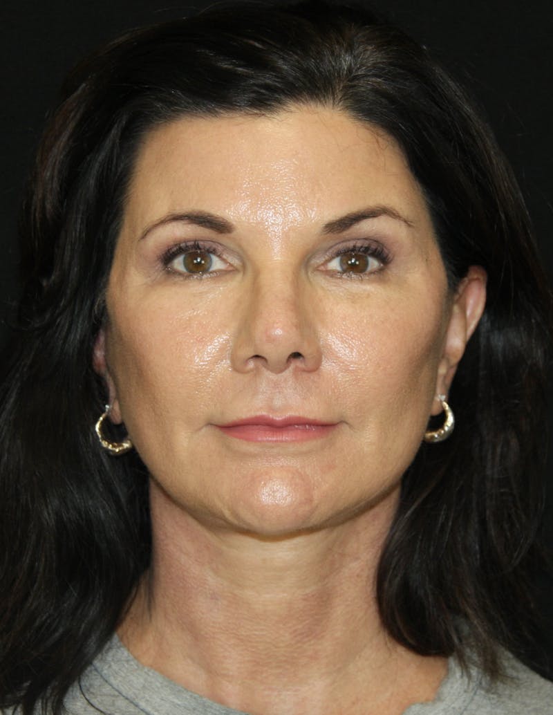 Facelift & Neck Lift Before & After Gallery - Patient 173372158 - Image 2