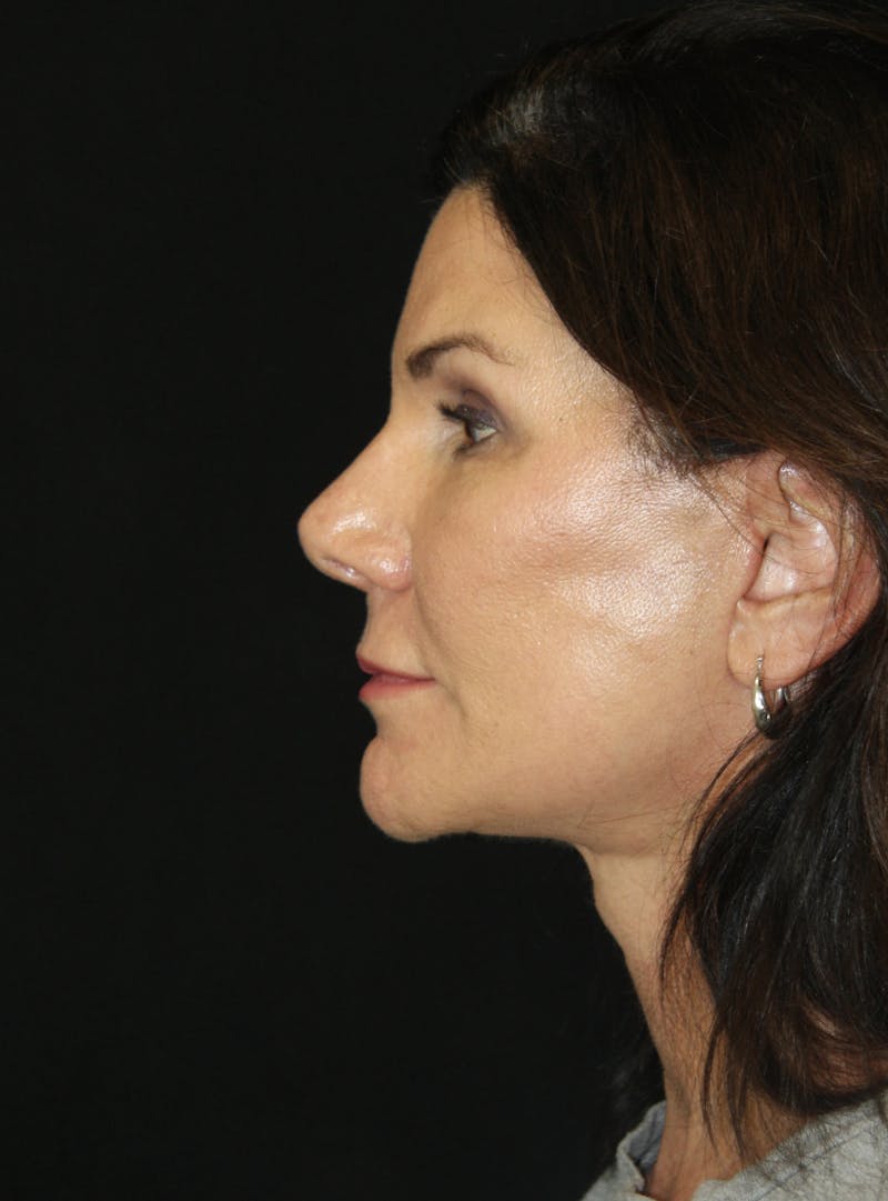 Facelift & Neck Lift Before & After Gallery - Patient 173372158 - Image 4