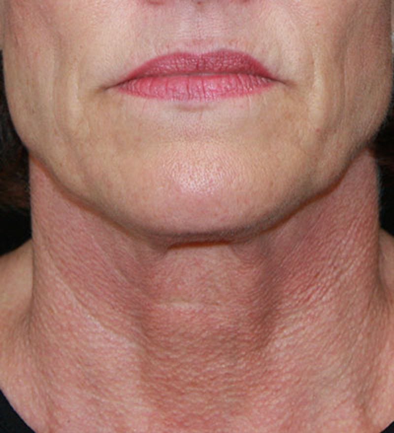 Facelift & Neck Lift Before & After Gallery - Patient 177544232 - Image 1