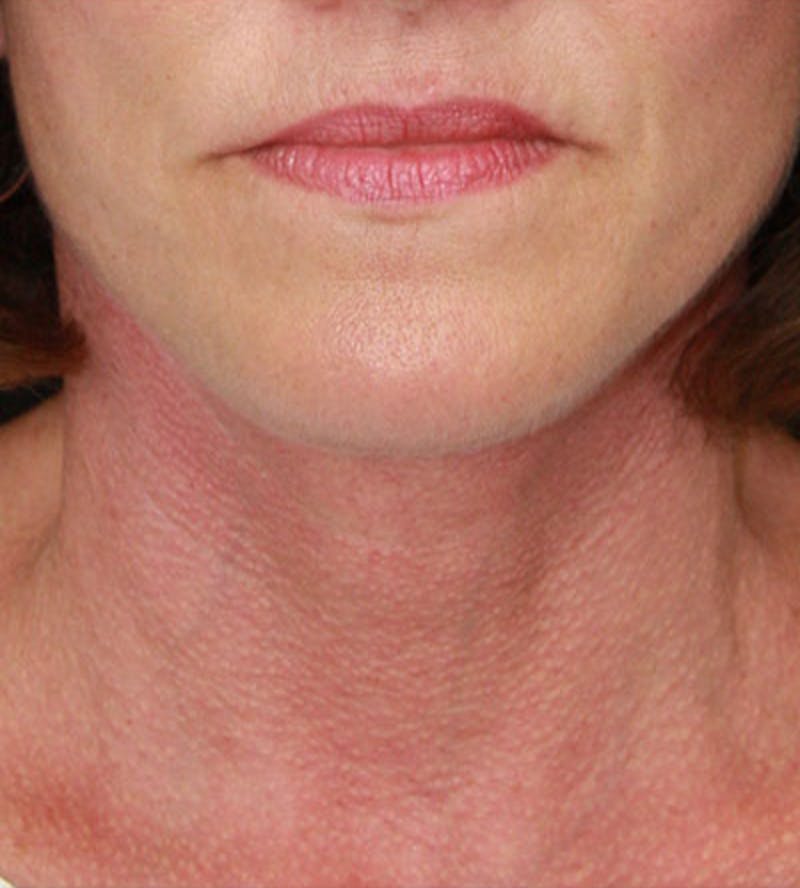 Facelift & Neck Lift Before & After Gallery - Patient 177544232 - Image 2