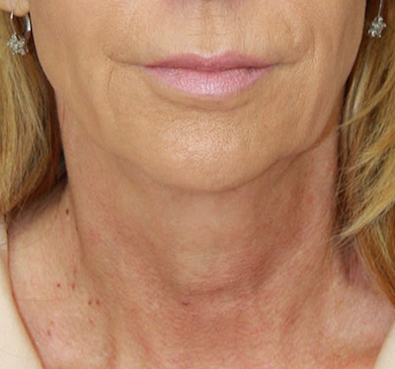 Facelift & Neck Lift Before & After Gallery - Patient 177551289 - Image 1