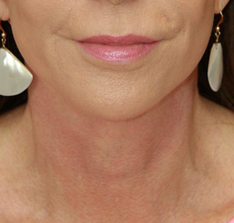 Facelift & Neck Lift Before & After Gallery - Patient 177551289 - Image 2