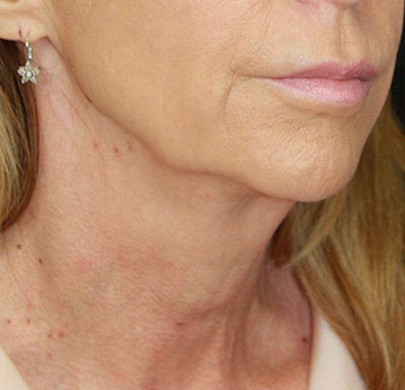 Facelift & Neck Lift Before & After Gallery - Patient 177551289 - Image 3