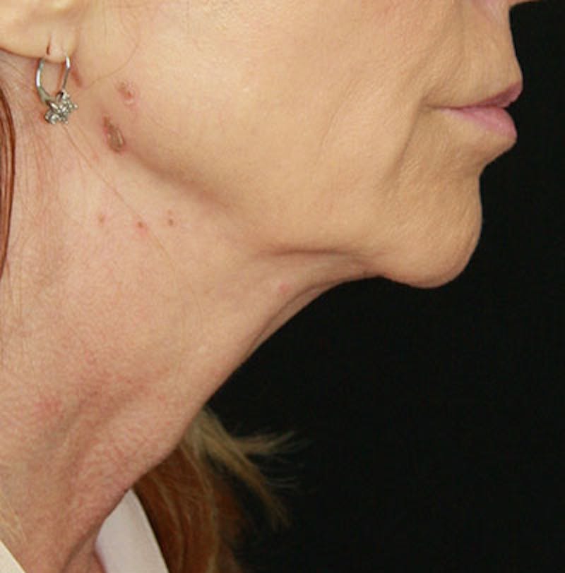 Facelift & Neck Lift Before & After Gallery - Patient 177551289 - Image 5