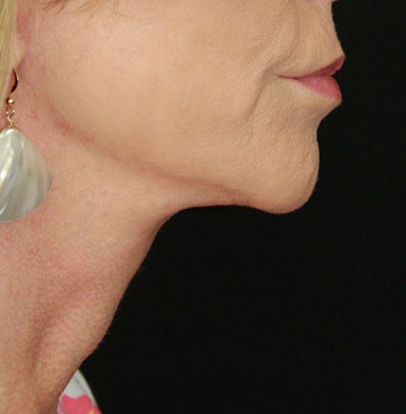 Facelift & Neck Lift Before & After Gallery - Patient 177551289 - Image 6