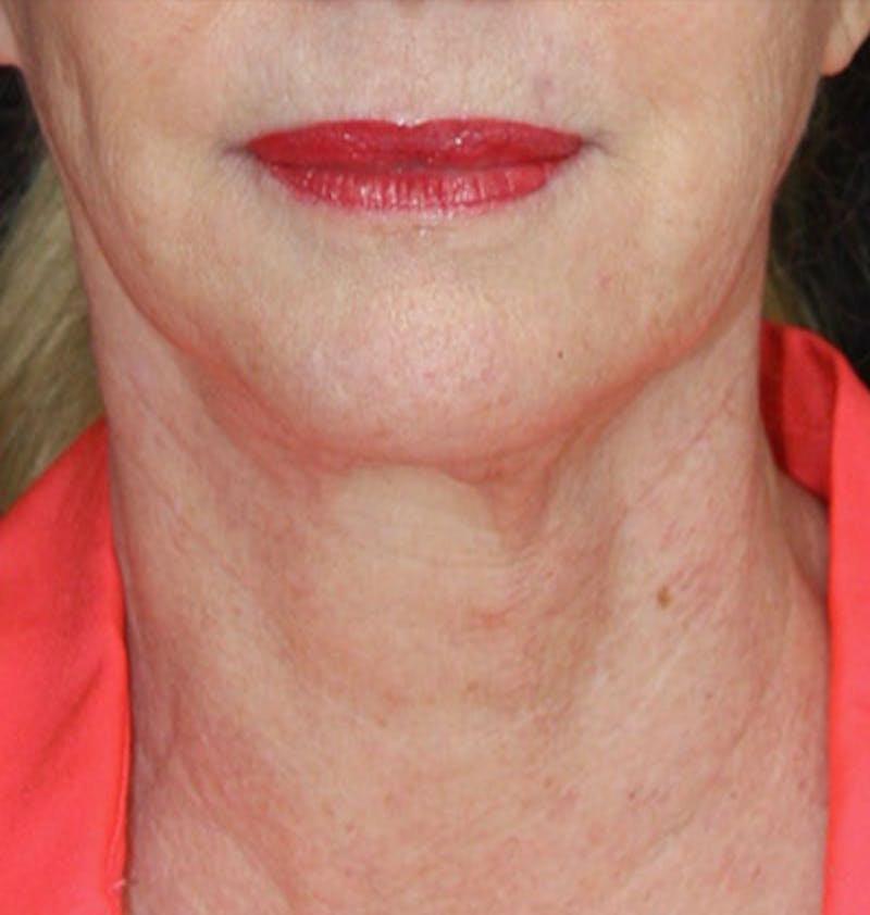 Facelift & Neck Lift Before & After Gallery - Patient 177554658 - Image 1