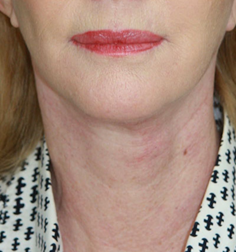 Facelift & Neck Lift Before & After Gallery - Patient 177554658 - Image 2