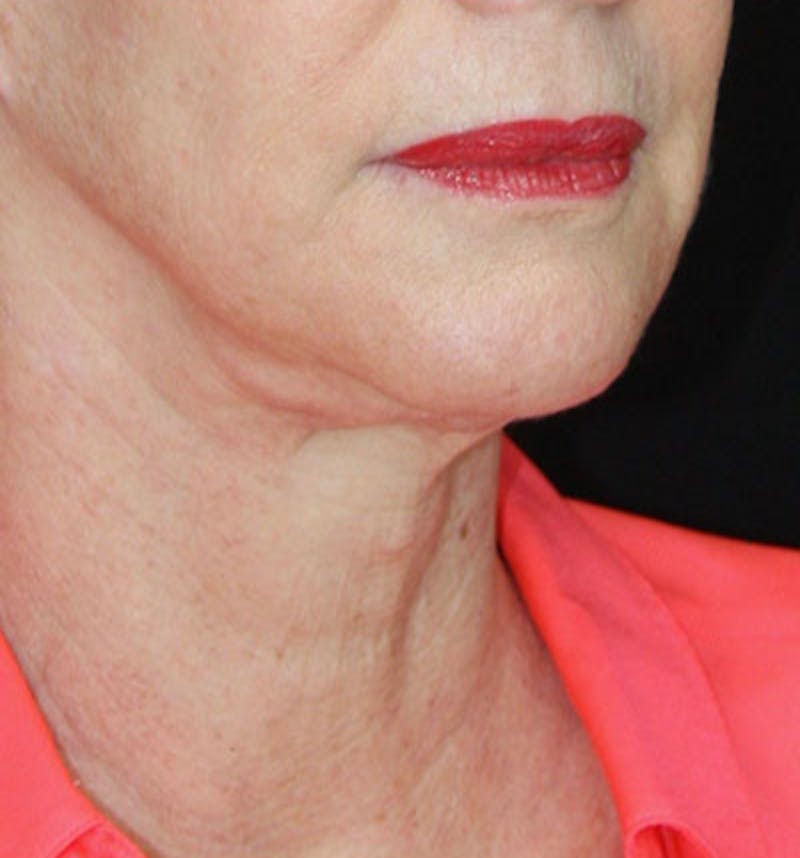 Facelift & Neck Lift Before & After Gallery - Patient 177554658 - Image 3