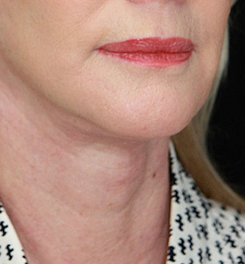 Facelift & Neck Lift Before & After Gallery - Patient 177554658 - Image 4