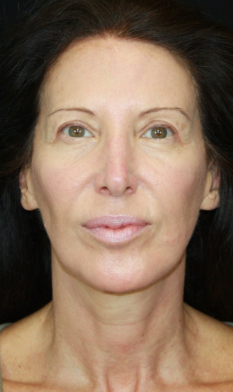 Brow Lift Before & After Gallery - Patient 178276895 - Image 1