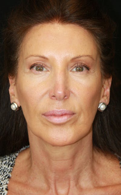 Brow Lift Before & After Gallery - Patient 178276895 - Image 2