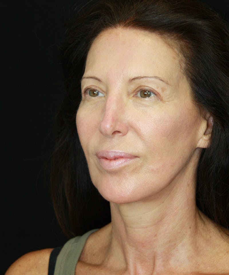 Brow Lift Before & After Gallery - Patient 178276895 - Image 3