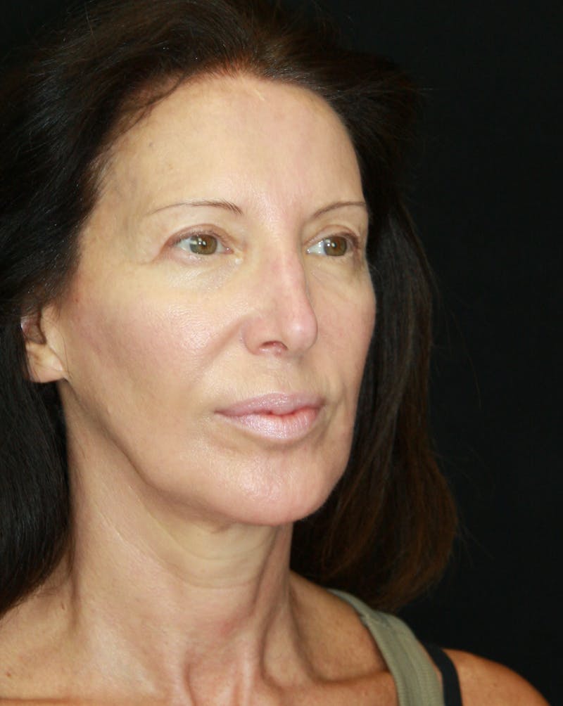 Brow Lift Before & After Gallery - Patient 178276895 - Image 5