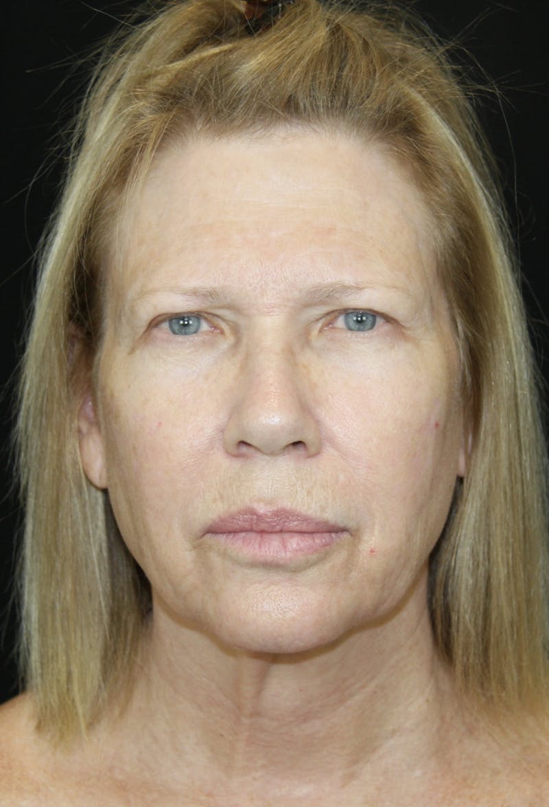 Brow Lift Before & After Gallery - Patient 178278765 - Image 1