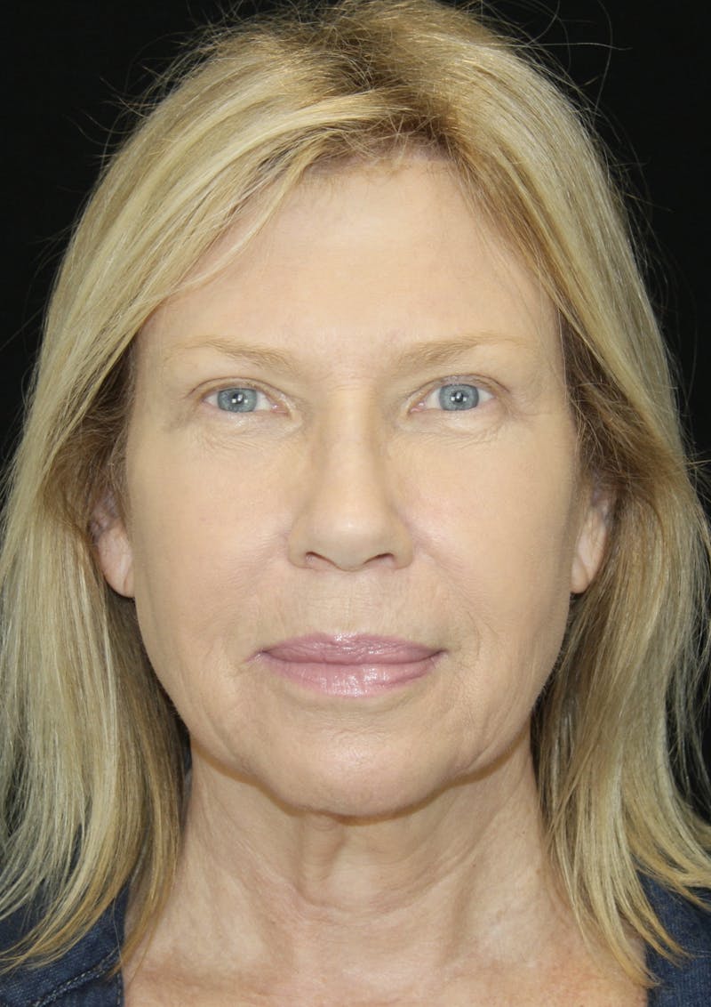 Brow Lift Before & After Gallery - Patient 178278765 - Image 2