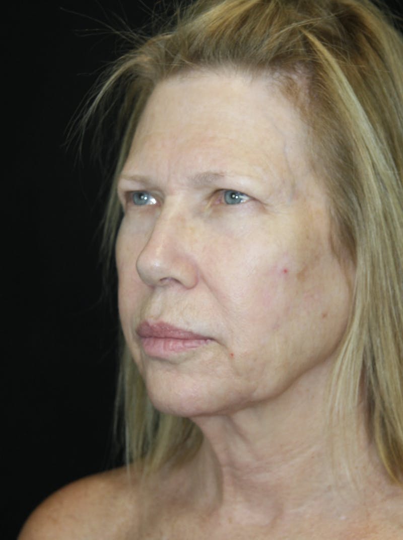 Brow Lift Before & After Gallery - Patient 178278765 - Image 3