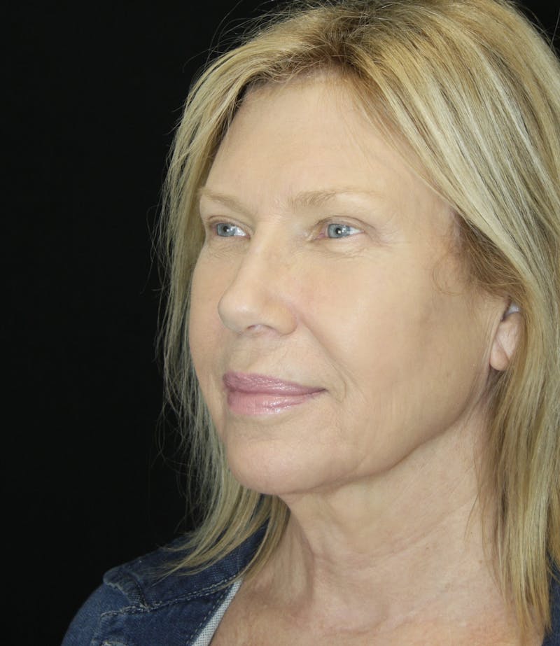 Brow Lift Before & After Gallery - Patient 178278765 - Image 4