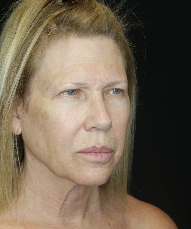Brow Lift Before & After Gallery - Patient 178278765 - Image 5