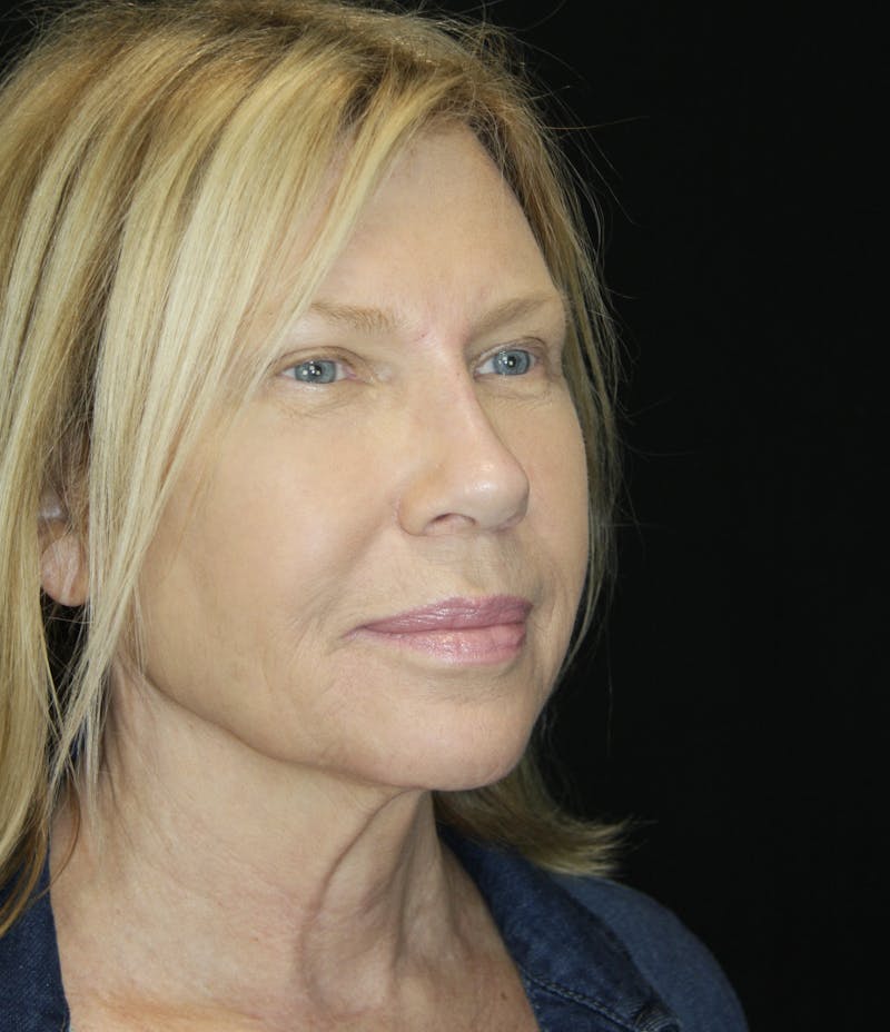 Brow Lift Before & After Gallery - Patient 178278765 - Image 6