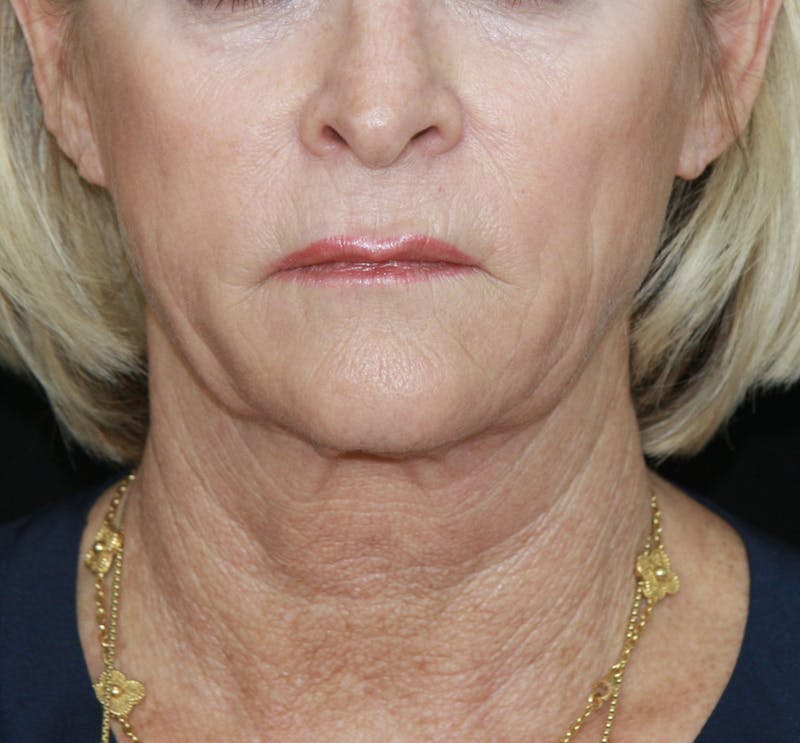 Facelift & Neck Lift Before & After Gallery - Patient 178281130 - Image 1