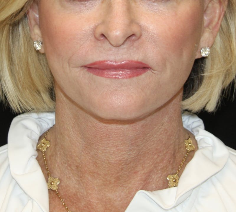 Facelift & Neck Lift Before & After Gallery - Patient 178281130 - Image 2