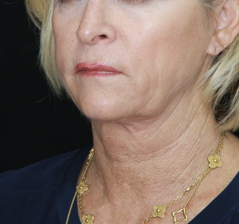 Facelift & Neck Lift Before & After Gallery - Patient 178281130 - Image 3