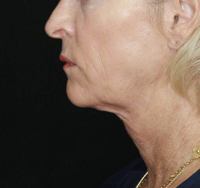 Facelift & Neck Lift Before & After Gallery - Patient 178281130 - Image 5