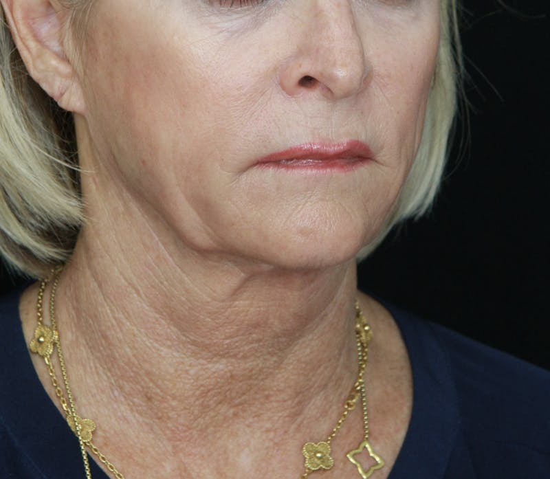 Facelift & Neck Lift Before & After Gallery - Patient 178281130 - Image 6
