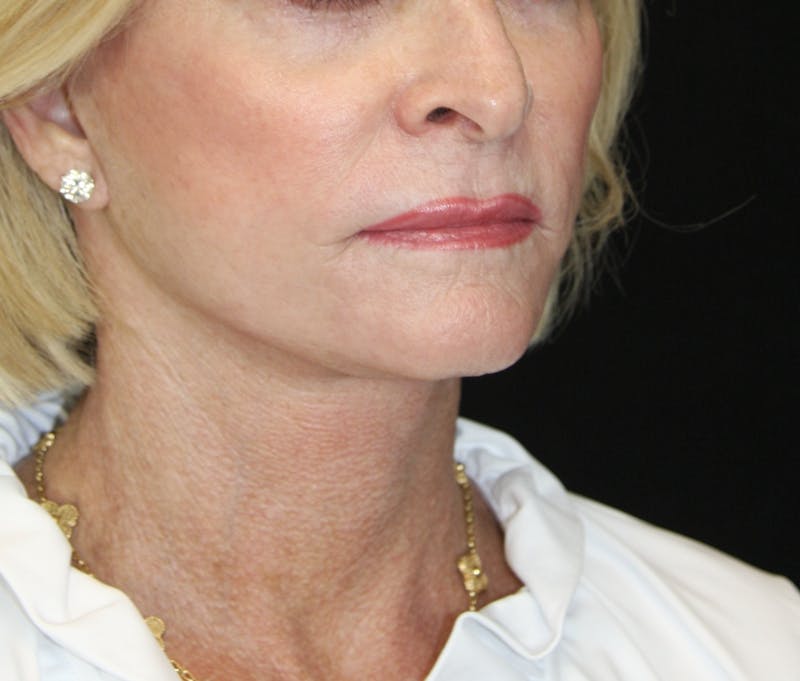Facelift & Neck Lift Before & After Gallery - Patient 178281130 - Image 7