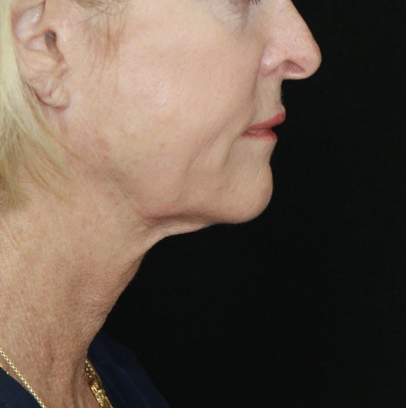 Facelift & Neck Lift Before & After Gallery - Patient 178281130 - Image 8