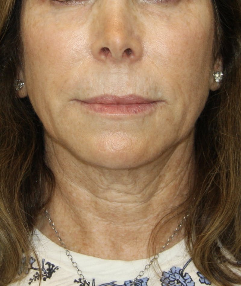 Facelift & Neck Lift Before & After Gallery - Patient 178281184 - Image 1
