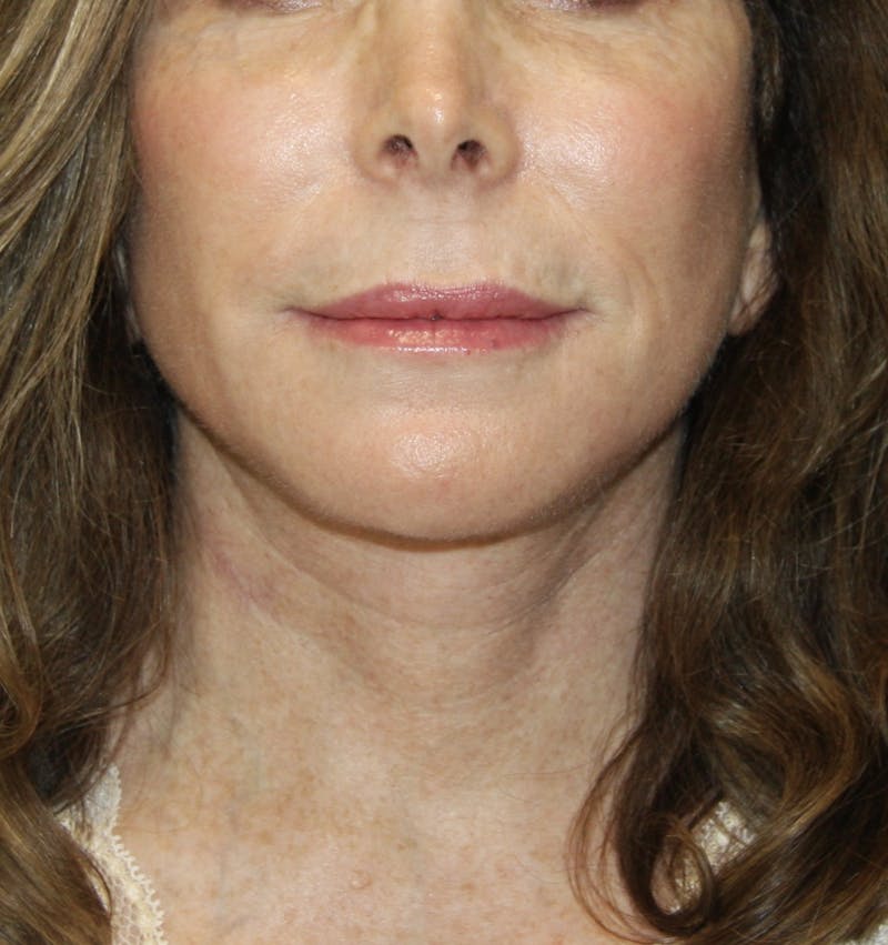 Facelift & Neck Lift Before & After Gallery - Patient 178281184 - Image 2