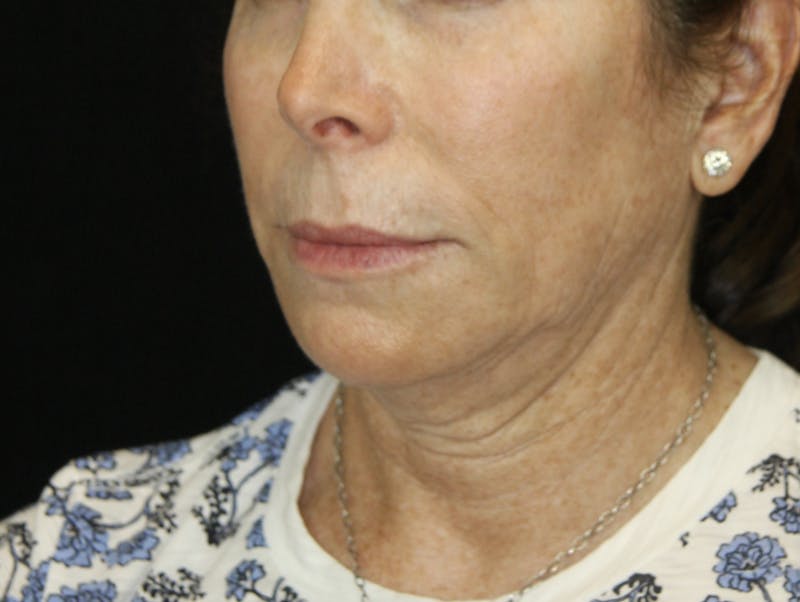 Facelift & Neck Lift Before & After Gallery - Patient 178281184 - Image 3
