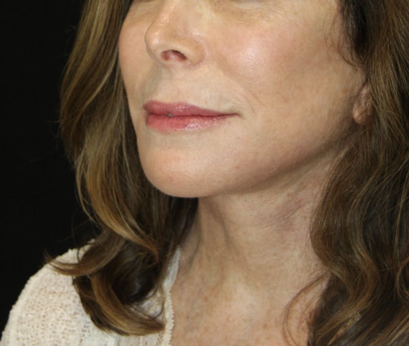 Facelift & Neck Lift Before & After Gallery - Patient 178281184 - Image 4