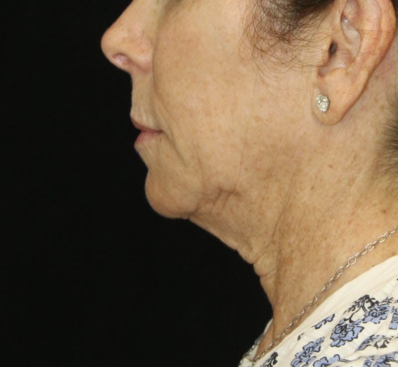 Facelift & Neck Lift Before & After Gallery - Patient 178281184 - Image 5