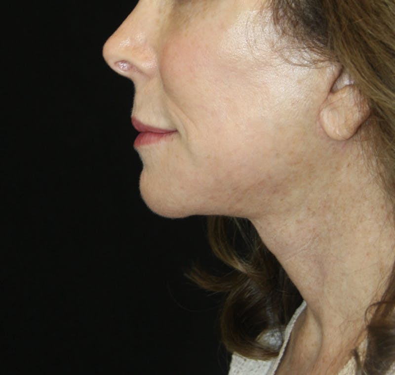 Facelift & Neck Lift Before & After Gallery - Patient 178281184 - Image 6