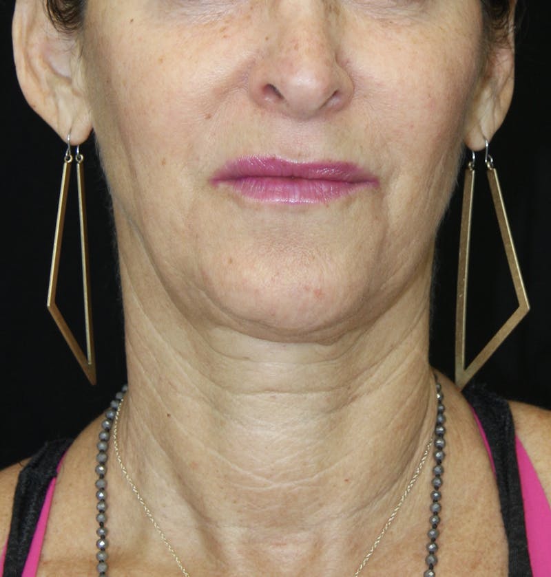 Facelift & Neck Lift Before & After Gallery - Patient 178281185 - Image 1