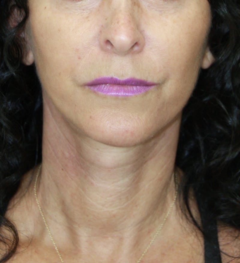 Facelift & Neck Lift Before & After Gallery - Patient 178281185 - Image 2