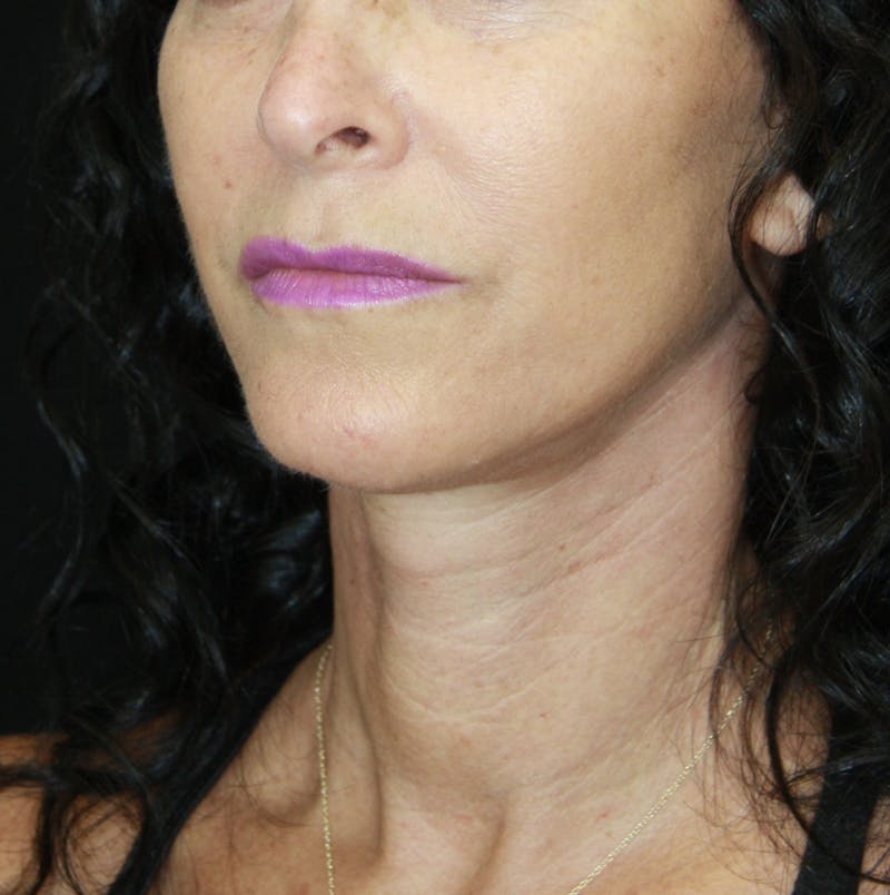 Facelift & Neck Lift Before & After Gallery - Patient 178281185 - Image 4