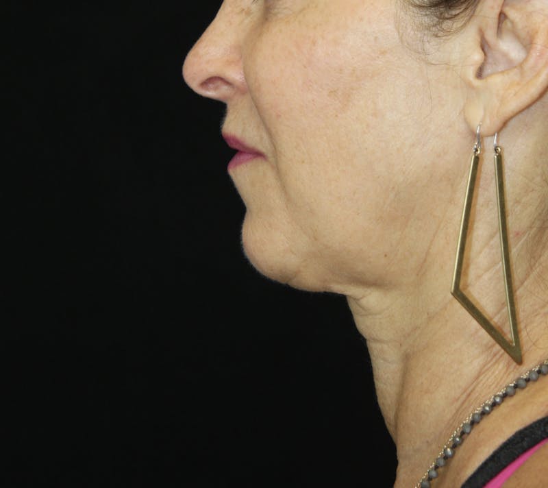 Facelift & Neck Lift Before & After Gallery - Patient 178281185 - Image 5