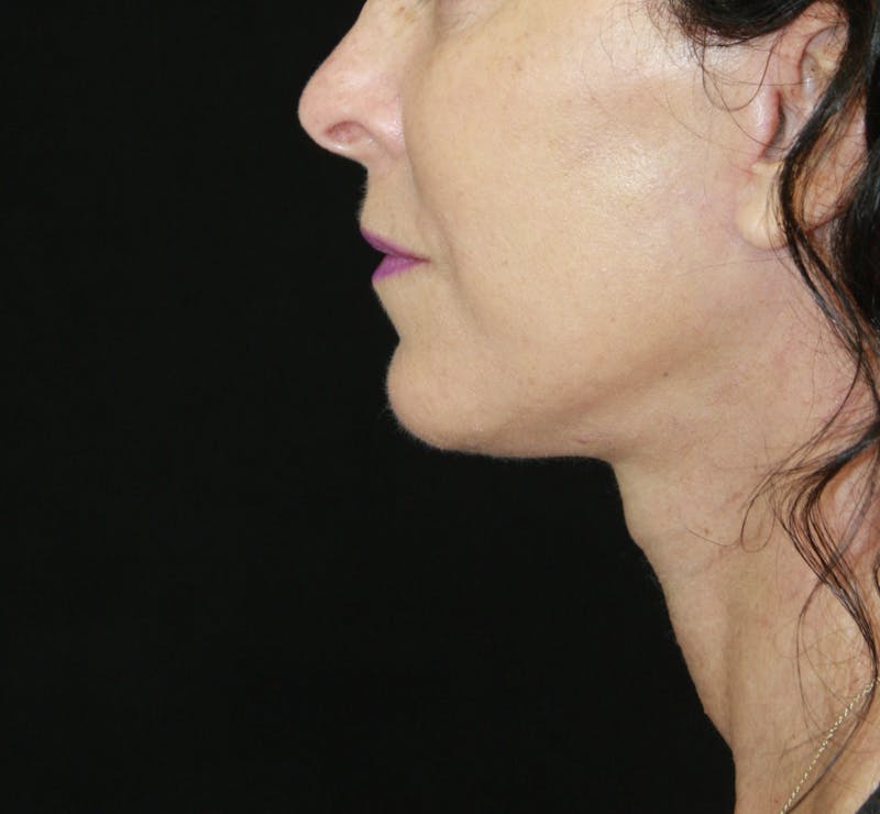 Facelift & Neck Lift Before & After Gallery - Patient 178281185 - Image 6
