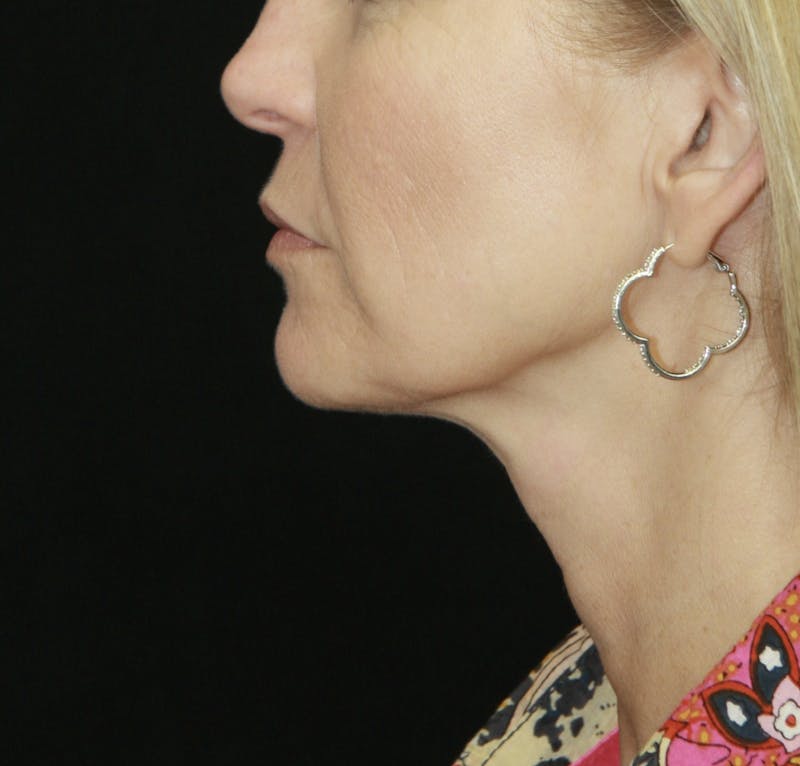 Facelift & Neck Lift Before & After Gallery - Patient 178281187 - Image 3