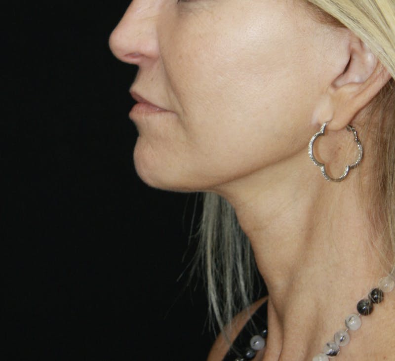 Facelift & Neck Lift Before & After Gallery - Patient 178281187 - Image 4