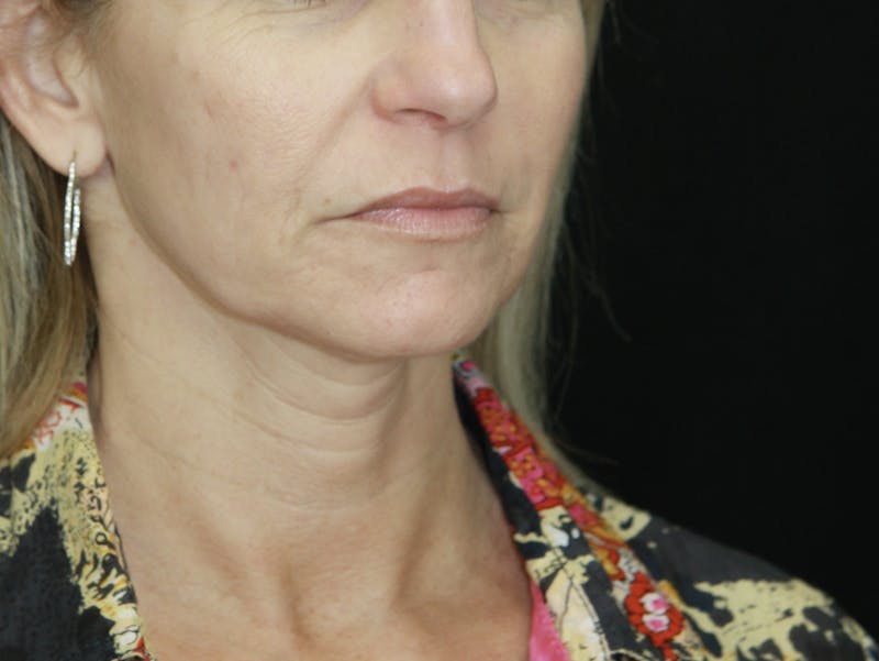 Facelift & Neck Lift Before & After Gallery - Patient 178281187 - Image 5