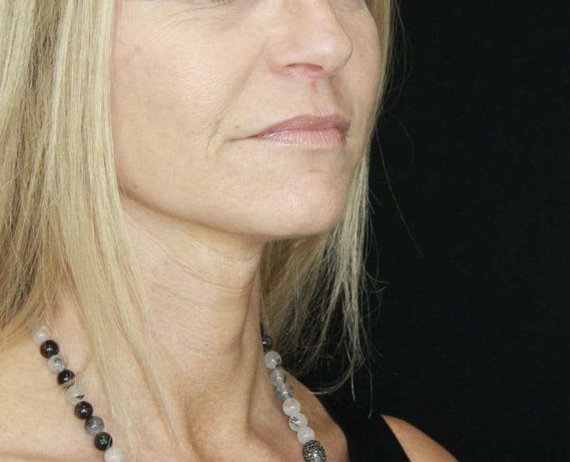 Facelift & Neck Lift Before & After Gallery - Patient 178281187 - Image 6