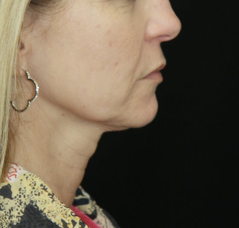 Facelift & Neck Lift Before & After Gallery - Patient 178281187 - Image 7